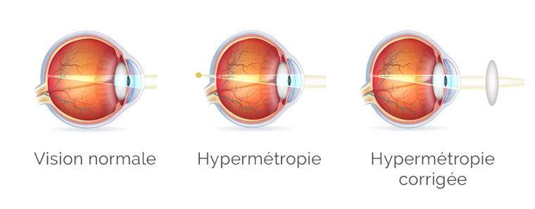 hypermetropie correction lentilles